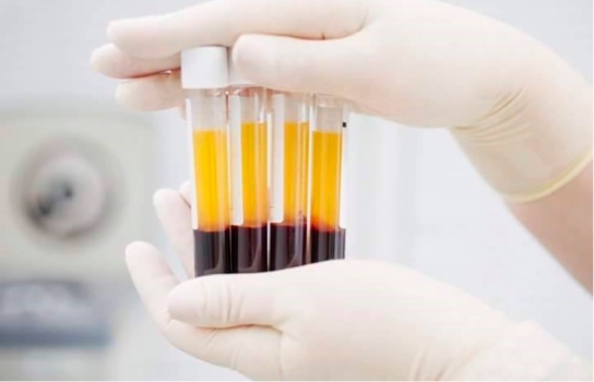 Platelet-Rich Plasma (PRP) Therapy